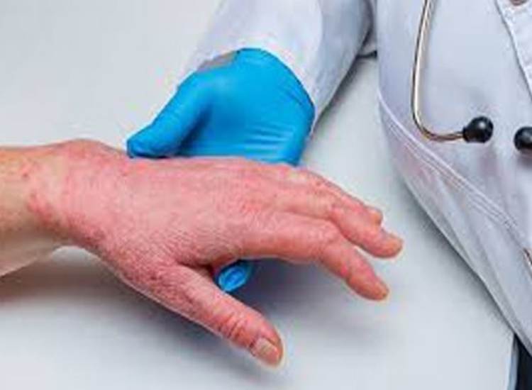 ألمانيا تسجِّل أول إصابة بسلالة جدري القرود